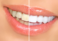 teeth whitening in Austin, TX before and after